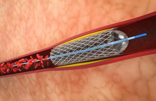 medical implants for the treatment of vascular diseases2