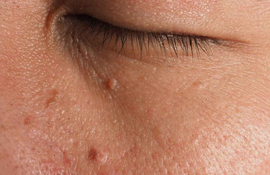 טיפולי אסתטיקה להסרת נגעי עור2